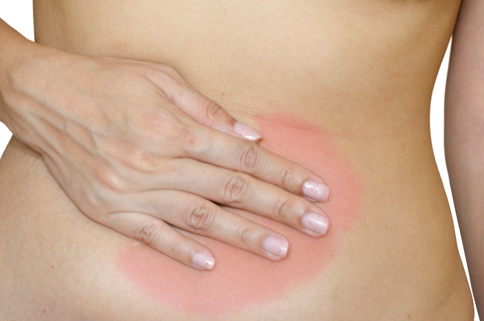 Endometriosis - Naturopathic Approaches